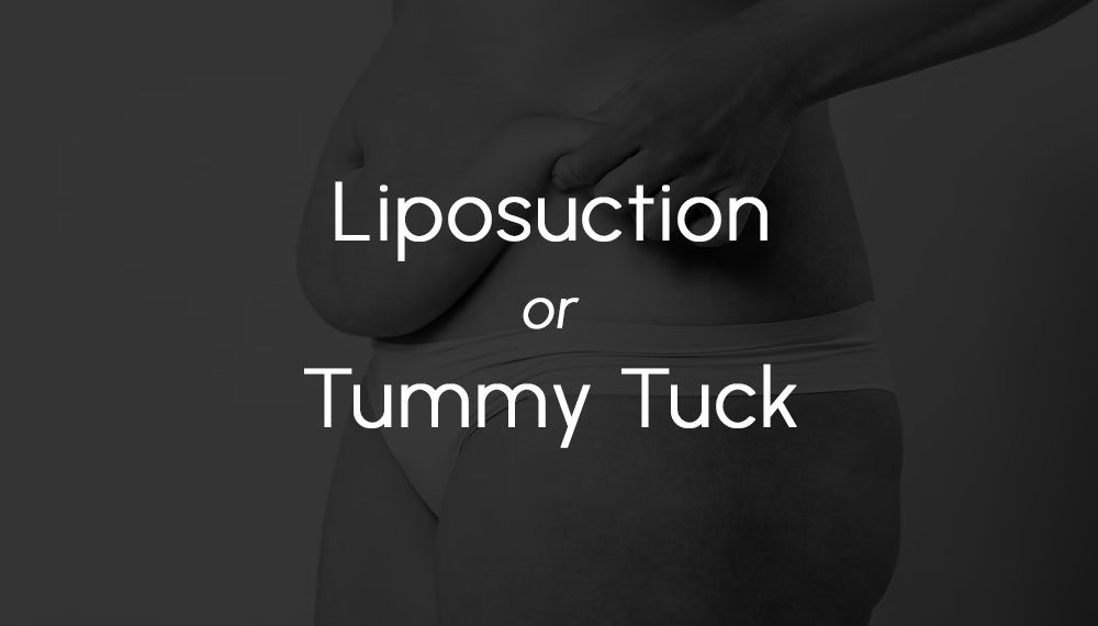 Liposuction or Tummy Tuck