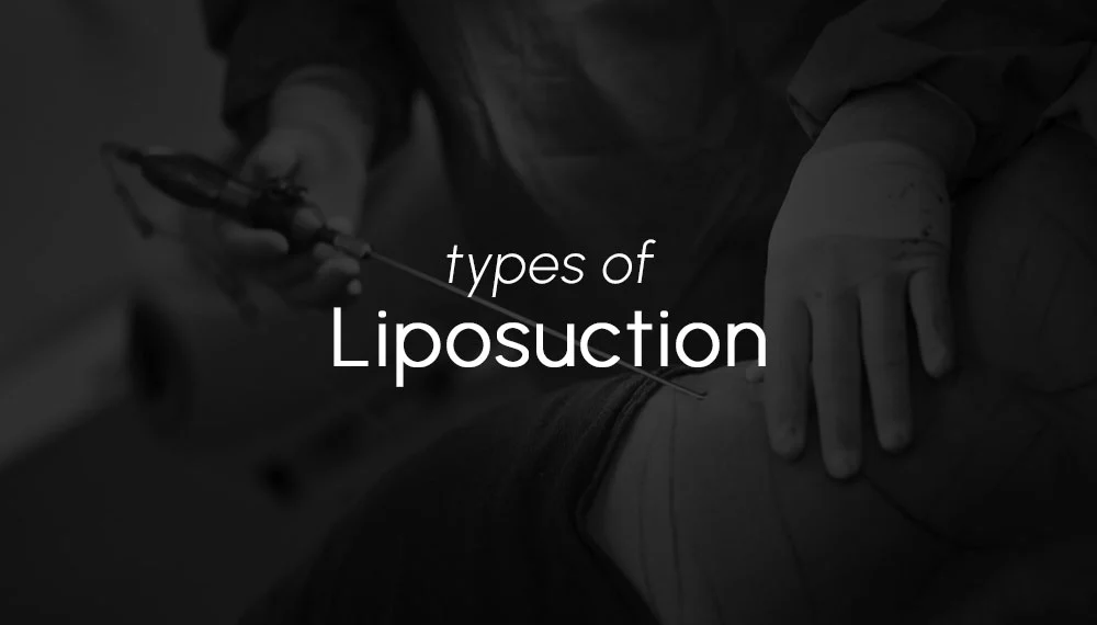 Types of Liposuction