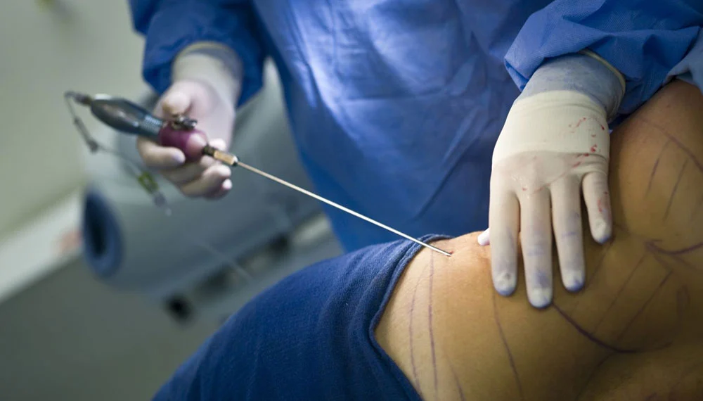 Liposuction in Abu Dhabi, Elyzee Hospital