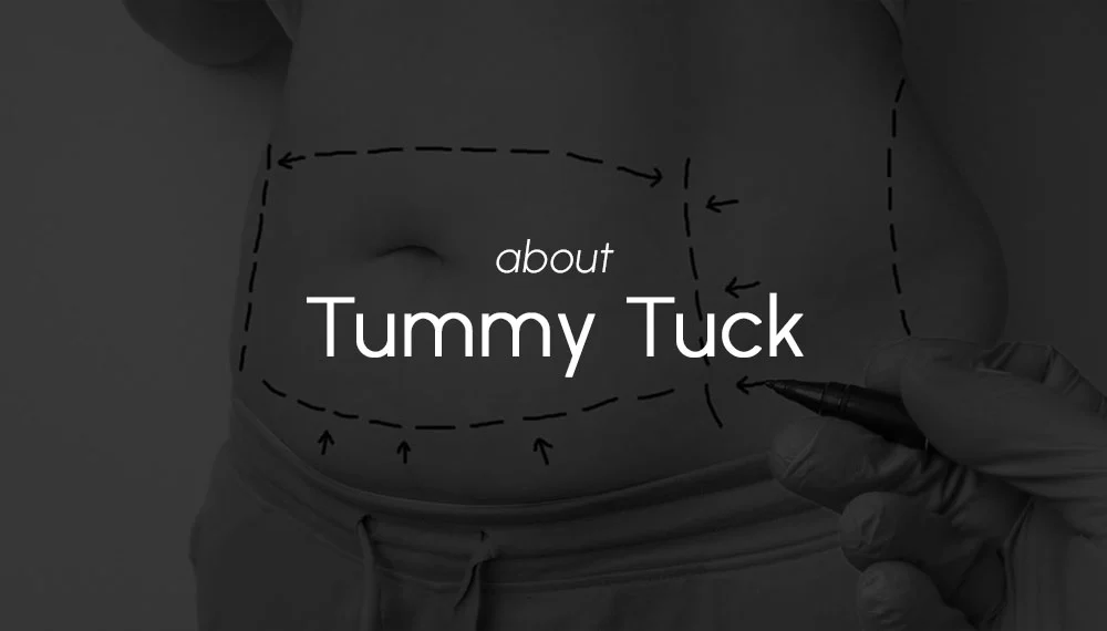 Everything You Need to Know About Tummy Tuck (Abdominoplasty)